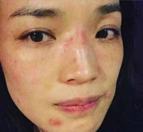 舒淇崩溃晒自拍照 北京柳絮爆发脸部过敏怎么办?